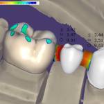 CAD CAM w protetyce i stomatologii