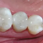 Odbudowa zęba kompozytem światłoutwardzalnym