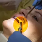 Wypełnienie kompozytowe zęba