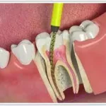 Leczenie kanałowe zęba - kiedy, etapy i ból